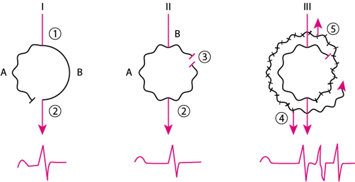 Typischer Reentry-Mechanismus