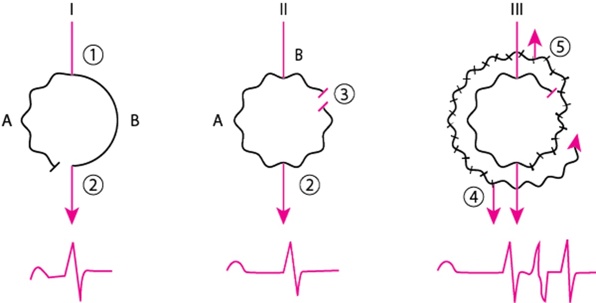 Mécanisme d'une réentrée typique