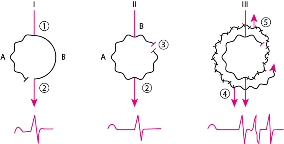 Mecanismos de reentrada típica