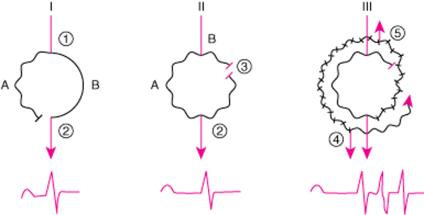 Механизм типичного реентри