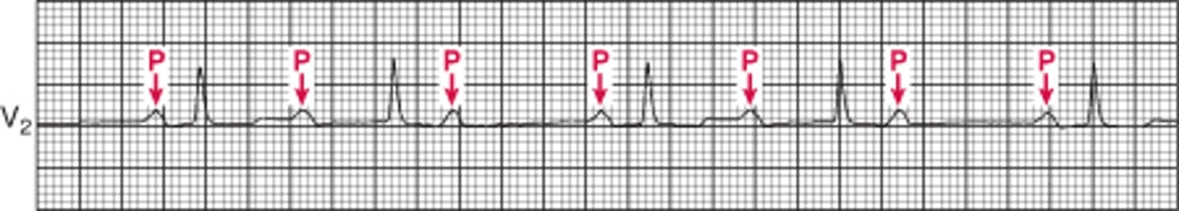 Classic Mobitz Type I Second-Degree Atrioventricular Block