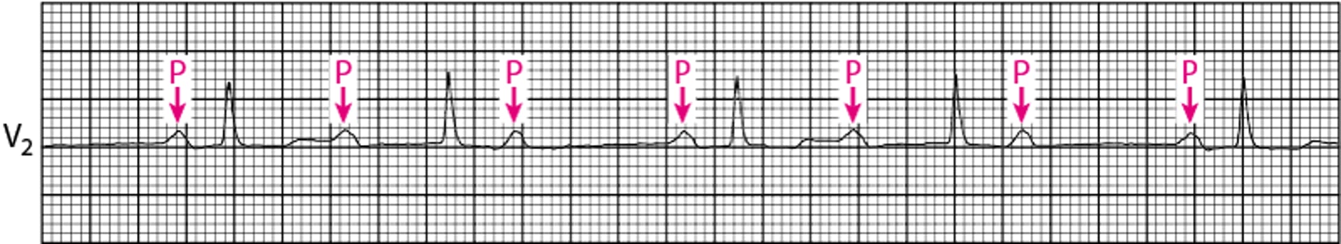 Klassischer atrioventrikulärer Block zweiten Grades vom Mobitz-Typ 1