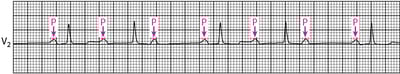 Bloqueo auriculoventricular de segundo grado tipo Mobitz I clásico