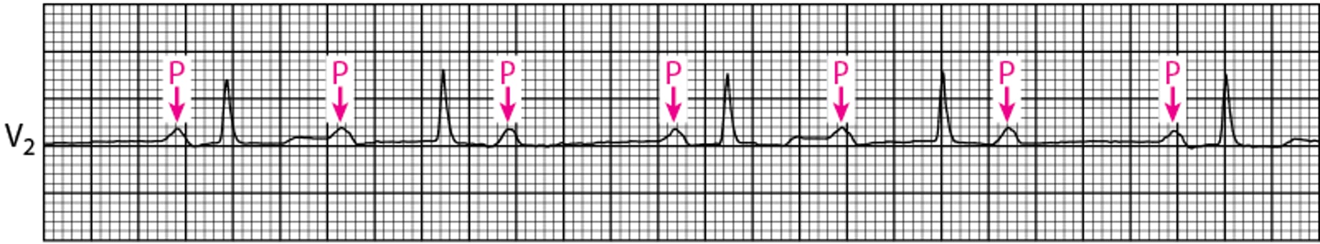 Bloqueo auriculoventricular de segundo grado tipo Mobitz I clásico