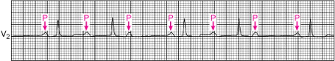 Mobitz I型第2度房室ブロック