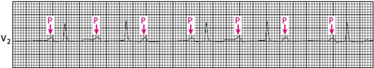 Bloqueio atrioventricular de segundo grau Mobitz tipo I clássico