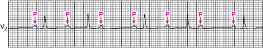 Классическая атриовентрикулярная блокада второй степени типа Мобитц I