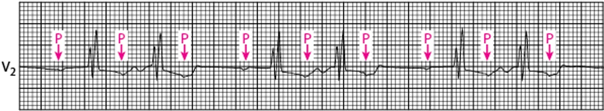 Mobitz type II second-degree atrioventricular block