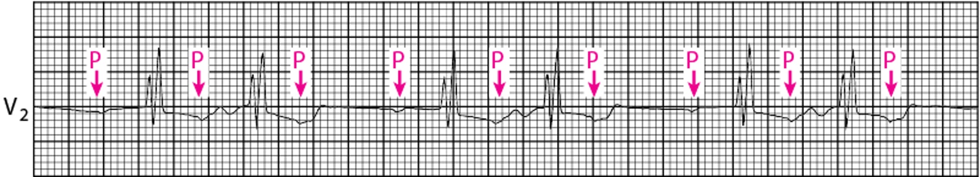 Bloqueo auriculoventricular de segundo grado tipo Mobitz II