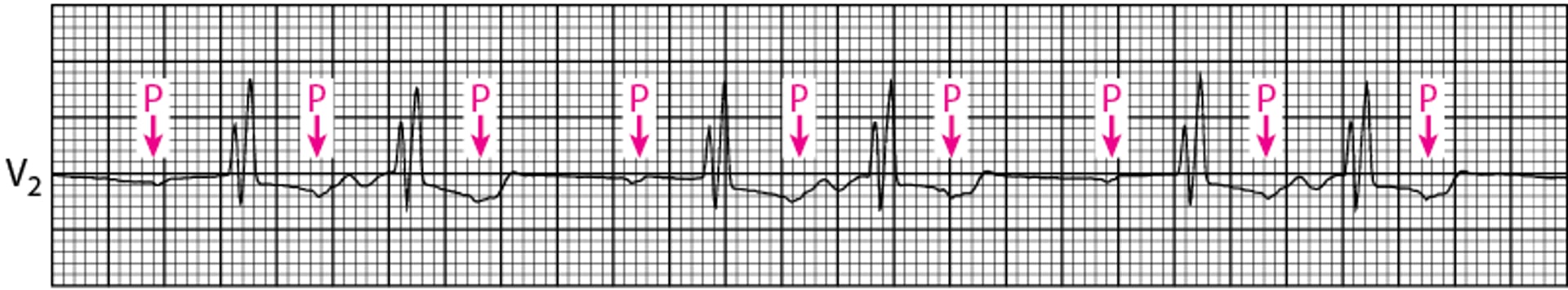 Bloc auriculoventriculaire de type Mobitz type II du 2e degré