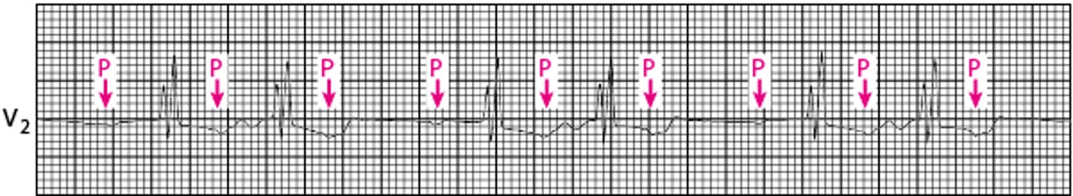 Bloqueio atrioventricular de segundo grau Mobitz tipo II
