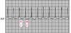Narrow QRS Tachycardia: Orthodromic Atrioventricular Reentrant Tachycardia Using an Accessory AV Connection in Wolff-Parkinson-White Syndrome