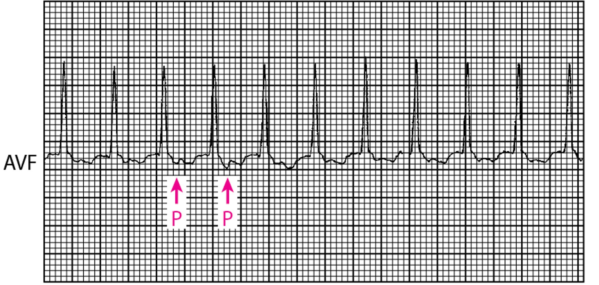 Taquicardia con complejo QRS estrecho: taquicardia por reentrada auriculoventricular ortodrómica mediante el uso de una conexión auriculoventricular accesoria en el síndrome de Wolff-Parkinson-White
