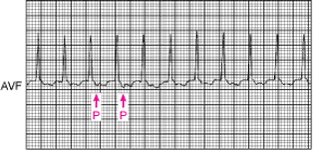 QRS幅の狭い頻拍：WPW症候群における副伝導路を介した正方向性回帰性頻拍