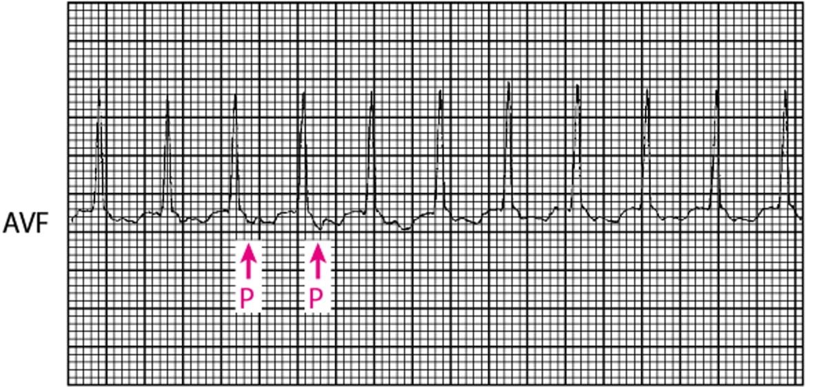 Taquicardia com QRS estreito: taquicardia por reentrada atrioventricular ortodrômica utilizando uma conexão AV acessória na síndrome de Wolff-Parkinson-White