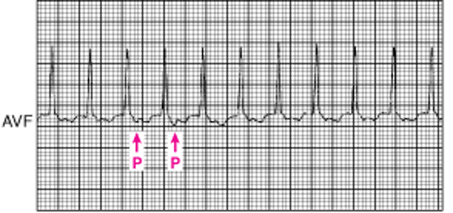 Тахикардия с узким комплексом QRS: ортодромная атриовентрикулярная реципрокная тахикардия с использованием дополнительного атриовентрикулярного соединения при синдроме Вольфа-Паркинсона-Уайта