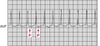 Nhịp nhanh QRS hẹp: Nhịp nhanh vòng vào lại nhĩ thất thuận chiều sử dụng kết nối AV phụ trong hội chứng Wolff-Parkinson-White