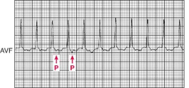 Nhịp nhanh QRS hẹp: Nhịp nhanh vòng vào lại nhĩ thất thuận chiều sử dụng kết nối AV phụ trong hội chứng Wolff-Parkinson-White