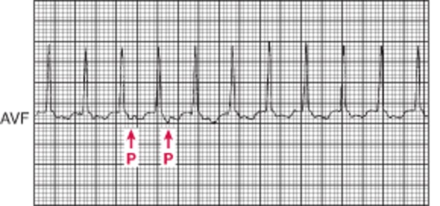 Cơn tim nhanh QRS thanh mảnh: Cơn tim nhanh do vòng vào lại nhĩ thất chiều xuôi thông qua đường dẫn truyền phụ trong hội chứng WPW.