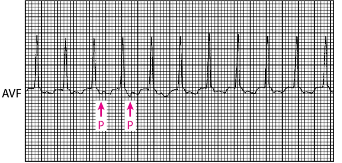 窄 QRS 心动过速：沃尔夫-帕金森-怀特综合征中使用辅助 AV 连接的正向性房室折返性心动过速