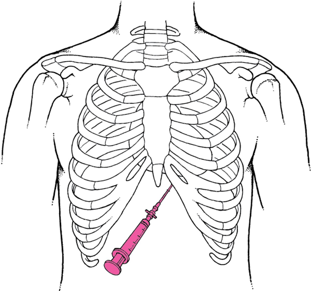 Pericardiocentesis