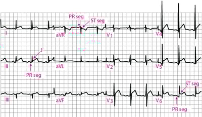 Acute Pericarditis: Stage 1 ECG