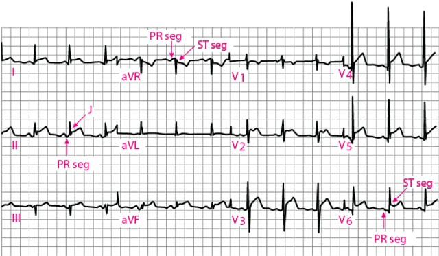 Image:Acute pericarditis: Stage 1 ECG-Merck Manual Professional Edition