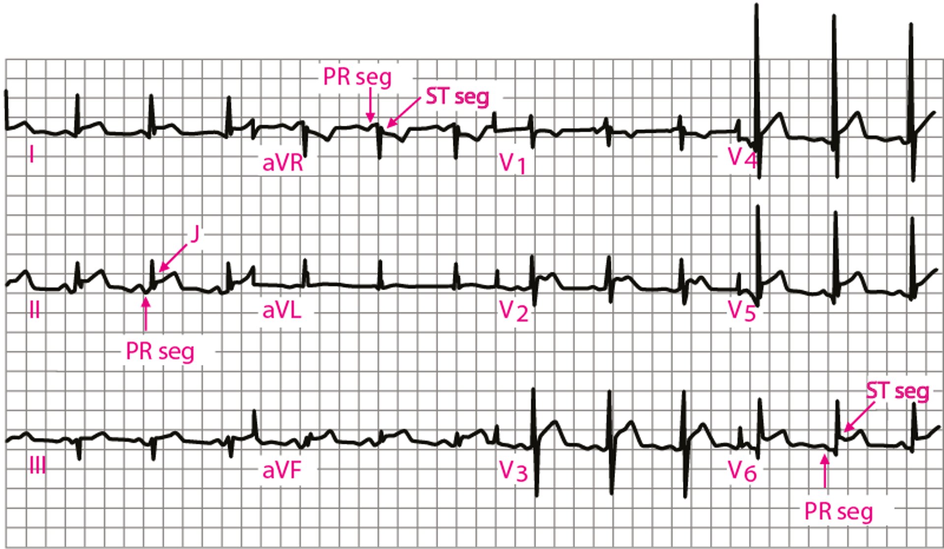 Akute Perikarditis: EKG Stufe 1