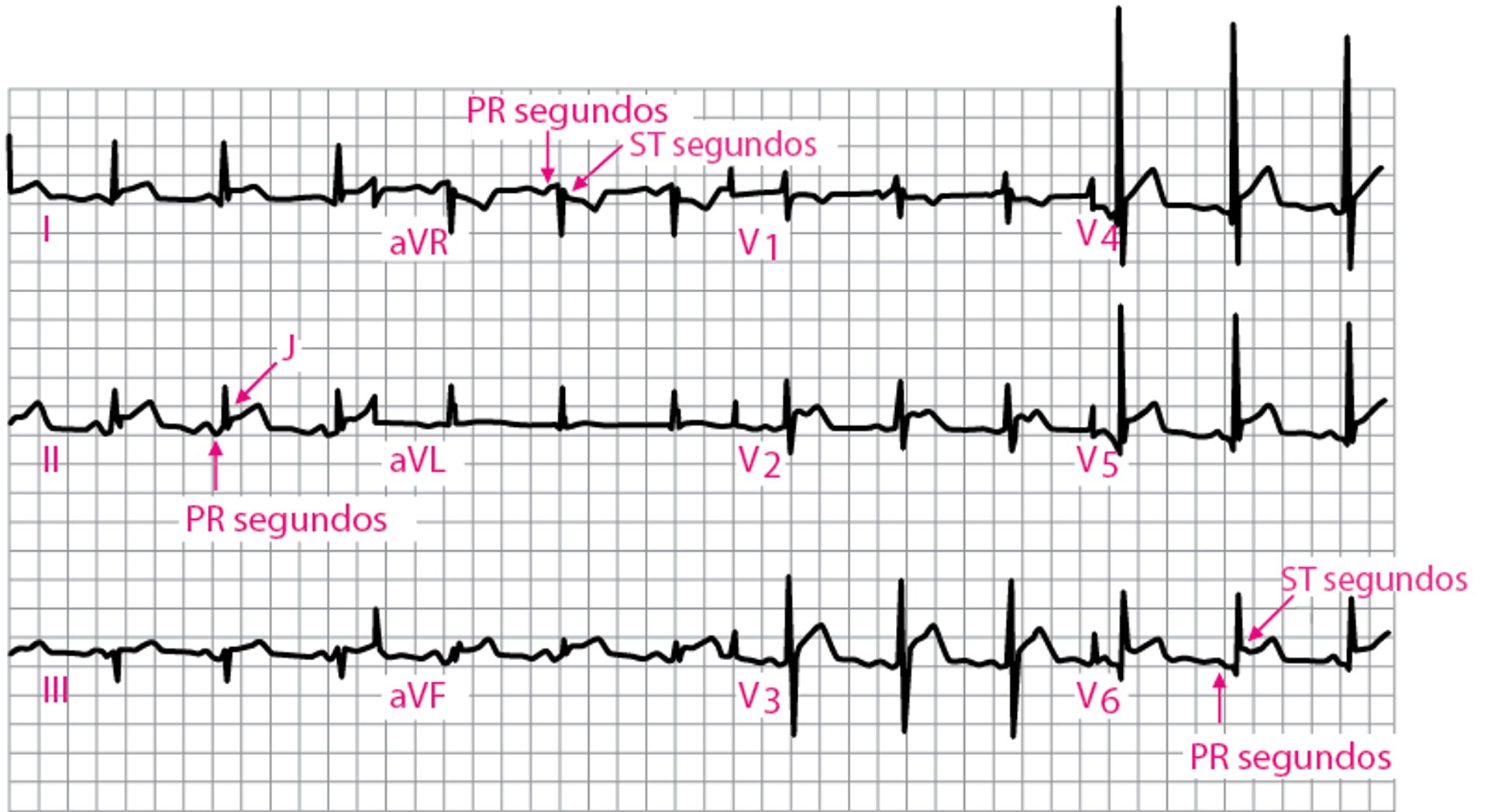 Pericarditis aguda: ECG del estadio 1