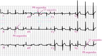 Pericarditis aguda: ECG del estadio 1