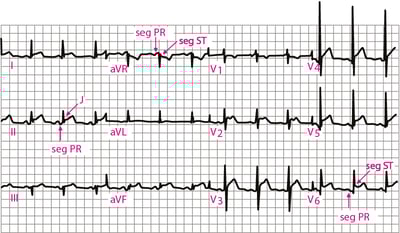 Péricardite aiguë: ECG stade 1