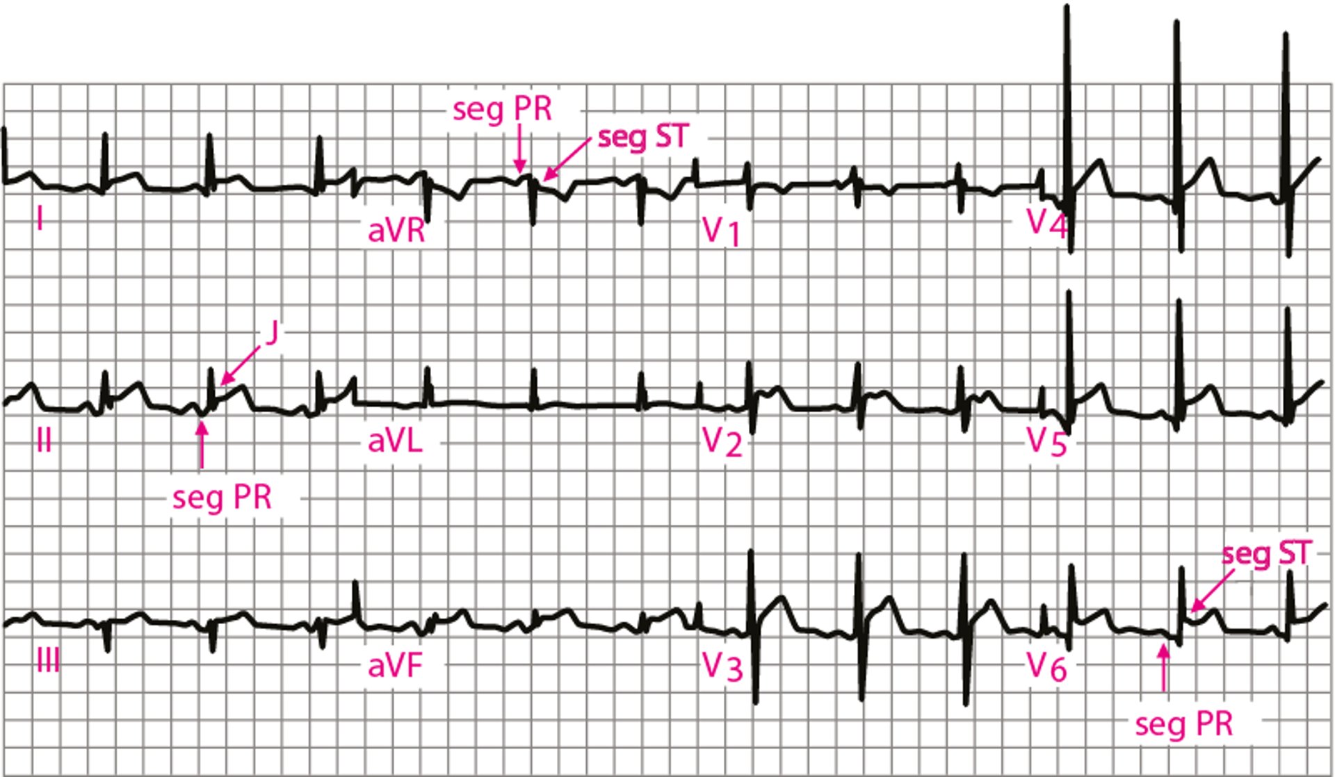 Pericardite acuta: fase 1 dell'ECG