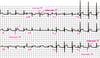 Pericardite aguda: ECG, estágio 1