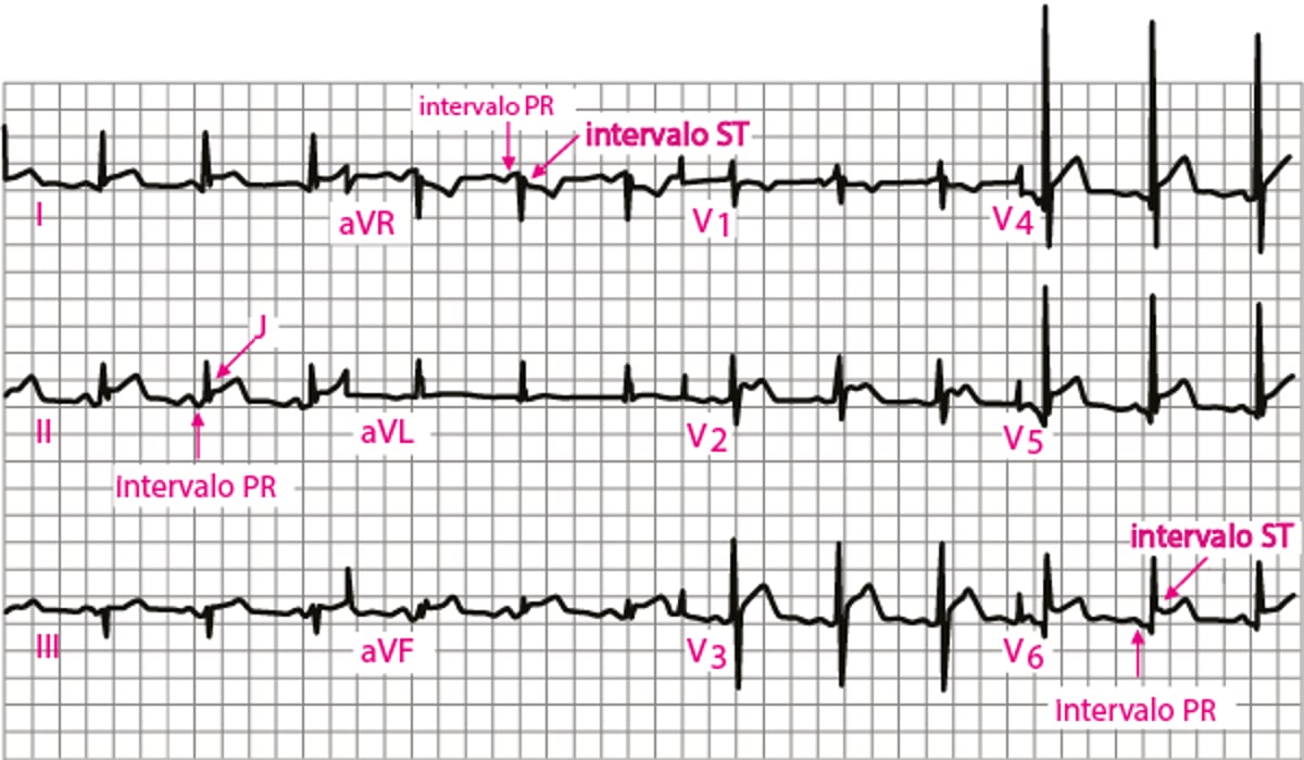 Pericardite aguda: ECG, estágio 1