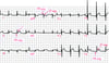 Viêm màng ngoài tim cấp tính: ECG Giai đoạn 1