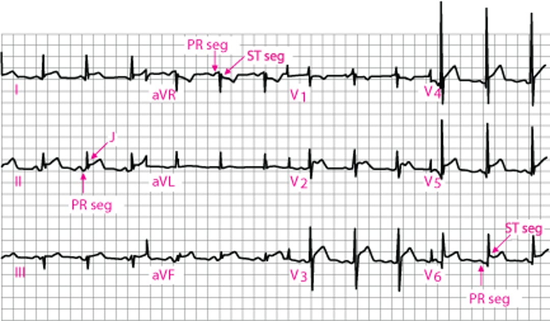 Viêm màng ngoài tim cấp tính: ECG Giai đoạn 1