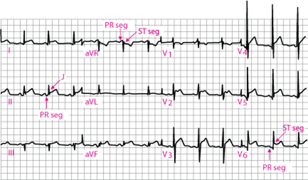 Viêm màng ngoài tim cấp trên điện tim: Giai đoạn 1.