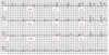 Right Bundle Branch Block
