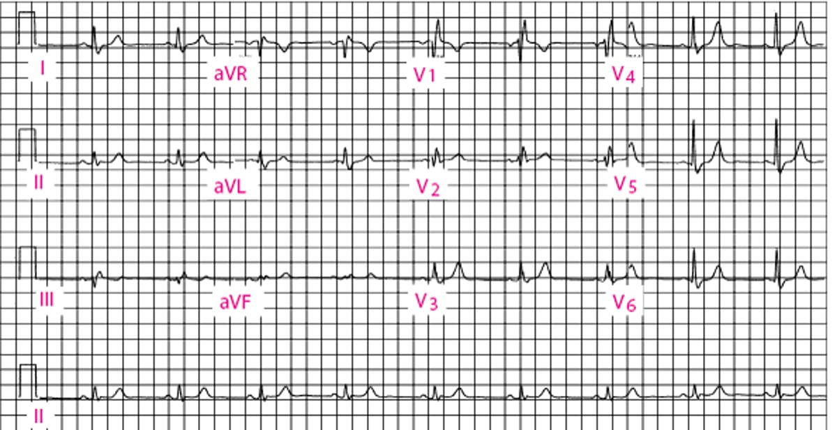 Right Bundle Branch Block