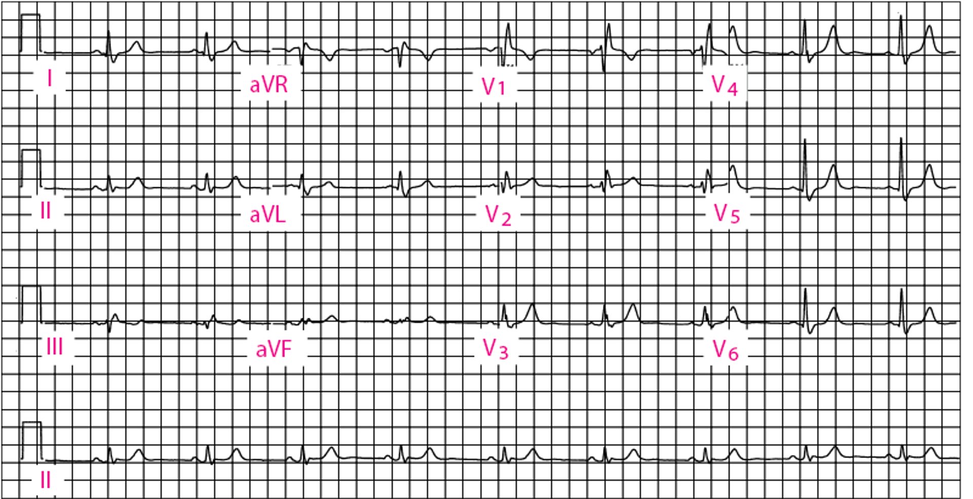 Blocco di branca destro