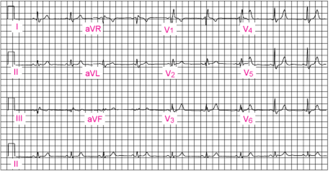 右脚ブロック