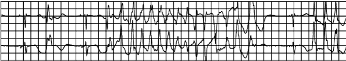 Torsades de Pointes Ventricular Tachycardia