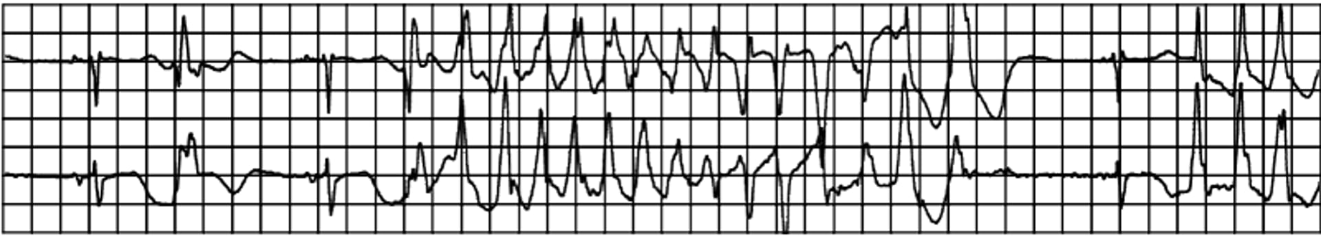 Taquicardia ventricular torsades de pointes