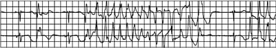 Taquicardia ventricular torsades de pointes