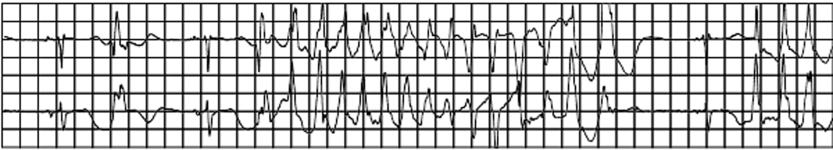 Taquicardia ventricular do tipo torsades de pointes
