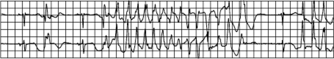 Желудочковая тахикардия Torsades de pointes