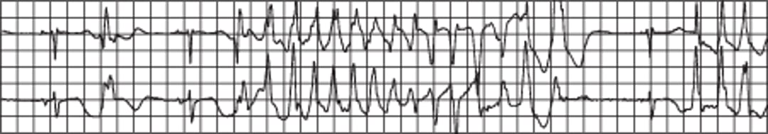 Nhịp nhanh thất xoắn đỉnh