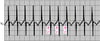 Focal Atrial Tachycardia