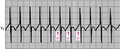 Focal Atrial Tachycardia