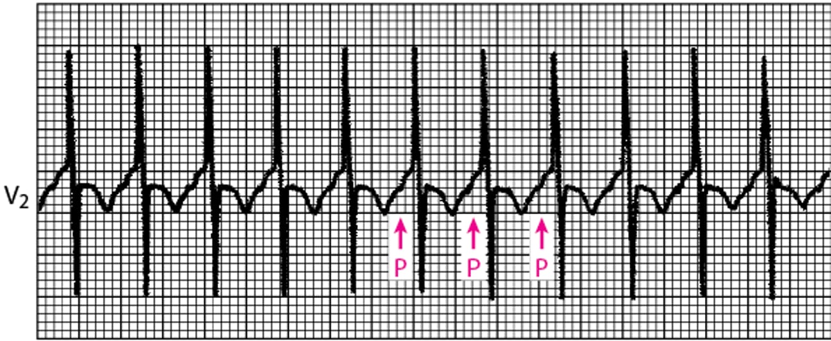 Focal Atrial Tachycardia